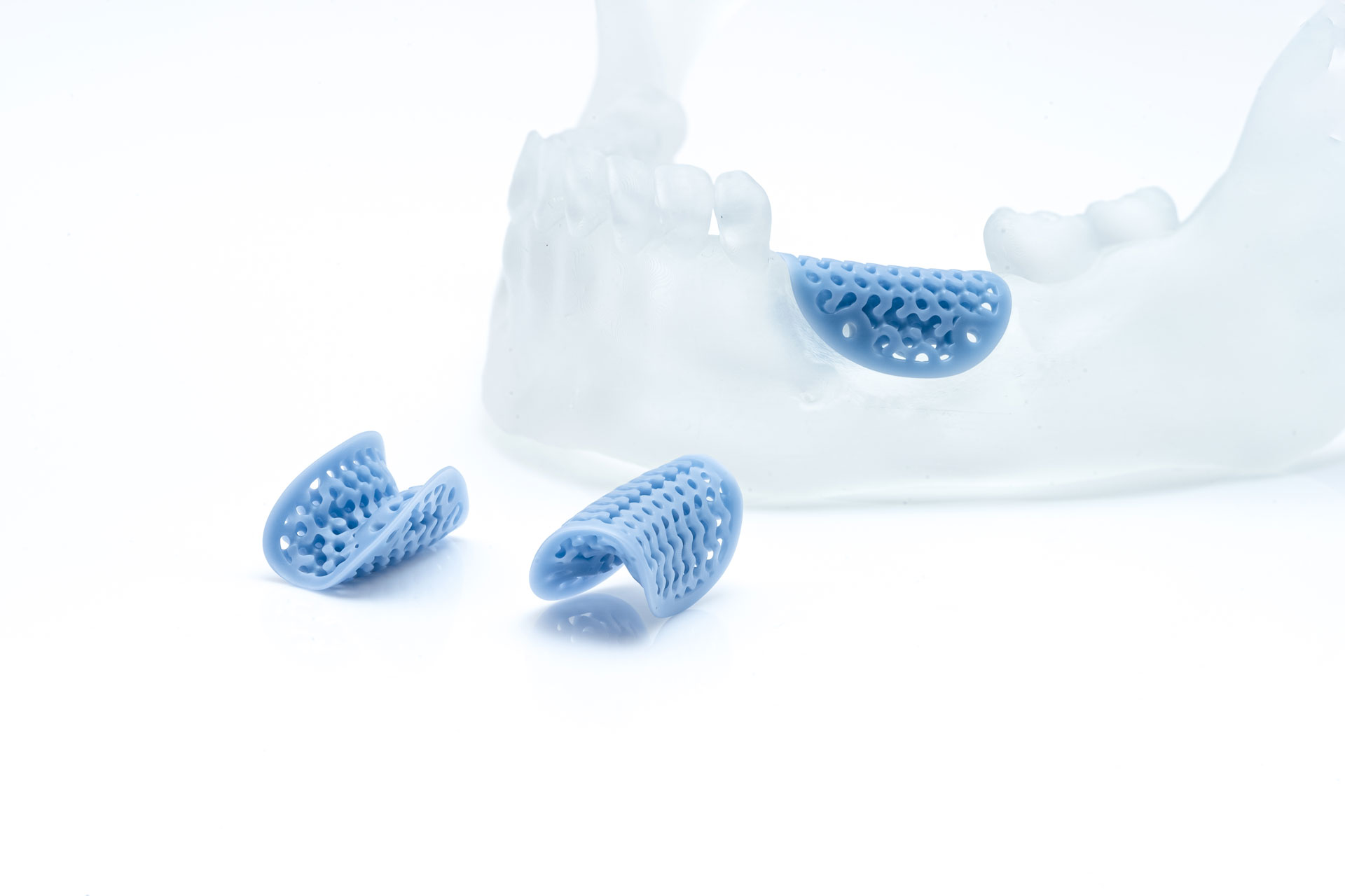 3D Printed Jaw Implant (Hydroxyapatite)